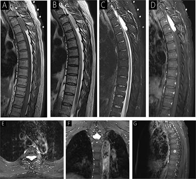 Spinal Epidural Cavernous Hemangiomas: A Clinical Series of 9 Cases and Literature Review